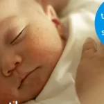 Granitos en la piel del bebé por el calor: Cómo tratar la sudamina