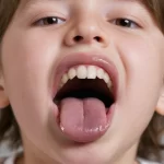 Enfermedades de la lengua marrón: diagnóstico seguro en niños con prudencia médica